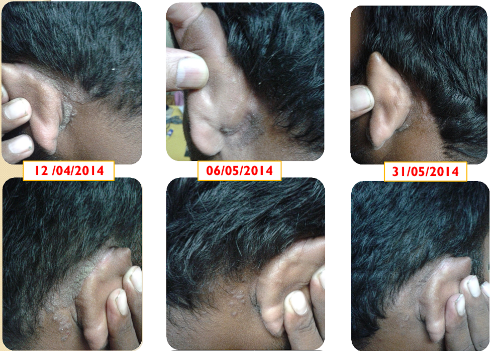 Case 3: Chronic Plaque Psoriasis - 30 years